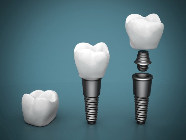 implanty zębów za i przeciw implanty warszawa